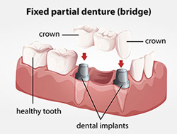 Dental Fillings | My Dentist | Alex Klim DDS | West Sacramento, CA
