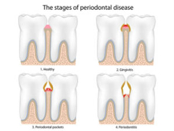 Gum Disease Treatment | My Dentist | Alex Klim DDS | West Sacramento, CA
