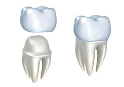 Dental Crowns | My Dentist | Alex Klim DDS | West Sacramento, CA