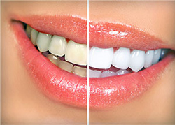 Take Home Whitening Kits | My Dentist | Alex Klim DDS | West Sacramento, CA